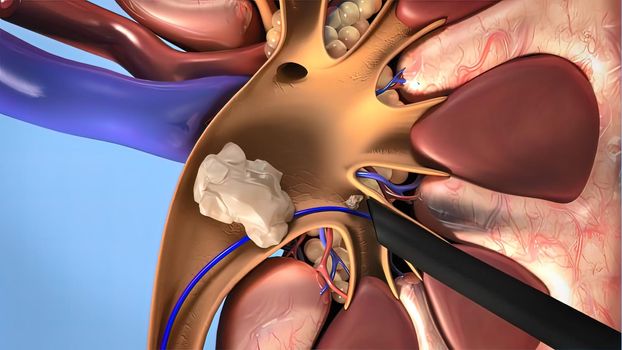 Kidney stones are small pebbles of salt and mineral in the urine. 3Dillustration