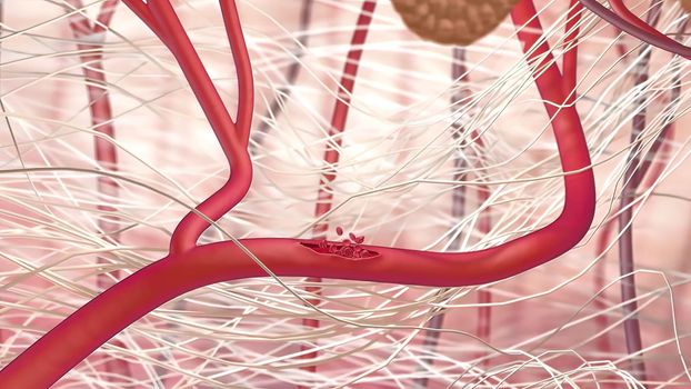 Internal bleeding is one of the most serious consequences of trauma. 3D illustration