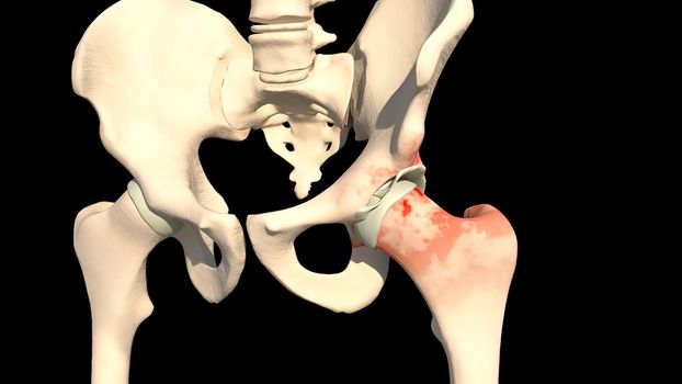 The thigh bone is the large upper leg bone that connects the lower leg bones to the pelvic bone 3D illustration