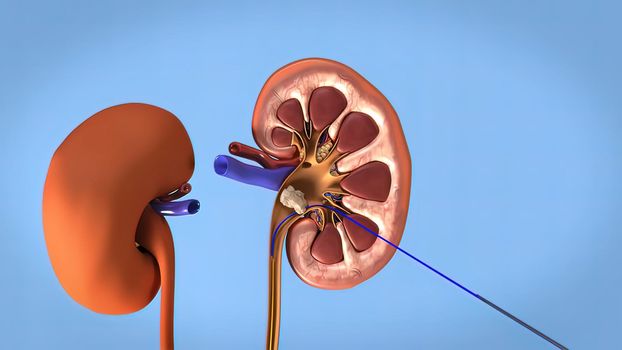 Kidney stones are small pebbles of salt and mineral in the urine. 3Dillustration