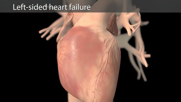 3D Animated right-sided heart failure - beating heart 3D illustration