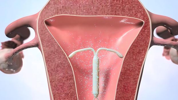 An IUD is a small device inserted into your uterus to prevent pregnancy. 3D illustration