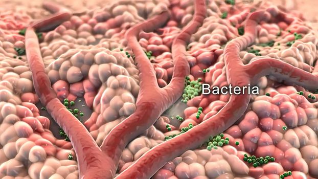 An abscess is a collection of pus that has built up within the tissue of the body. 3D illustration