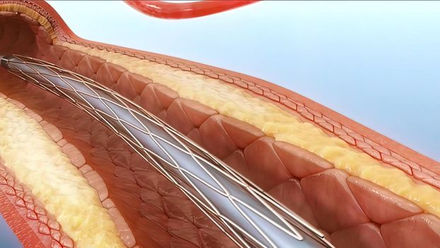 Angioplasty and Vascular Stenting, inserting a stent into vascular access 3D illustration