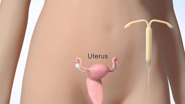 An IUD is a small device inserted into your uterus to prevent pregnancy. 3D illustration