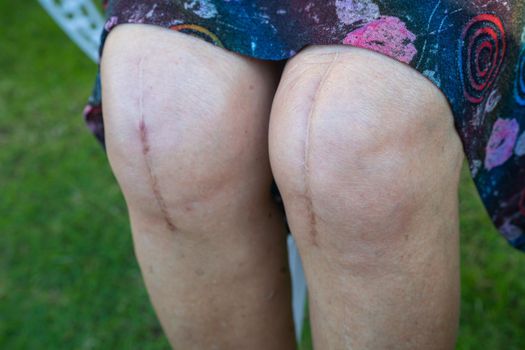 Asian senior lady old woman patient show her scars surgical total knee joint replacement.