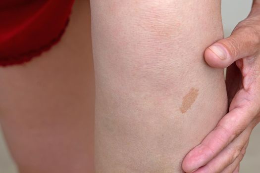 Cropped woman hands showing big birthmark on leg