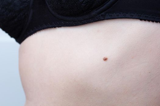 Birthmark on cropped woman body over white backgound