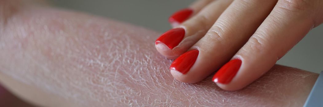 Close-up of female hand using burn cream after sunburn. Woman applying cosmetic protective product from sun. Summer holidays idea. Skincare and sunburn concept
