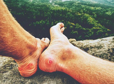 Man hiker sweaty legs with horrible painful callus resting on mountain peak. Misty rocky landscape  with a valley at background