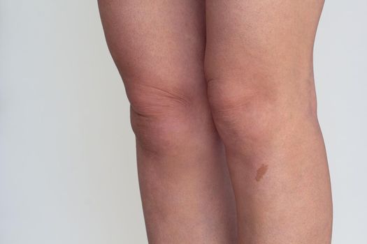 Cropped woman legs with permanent oval birthmark on white background