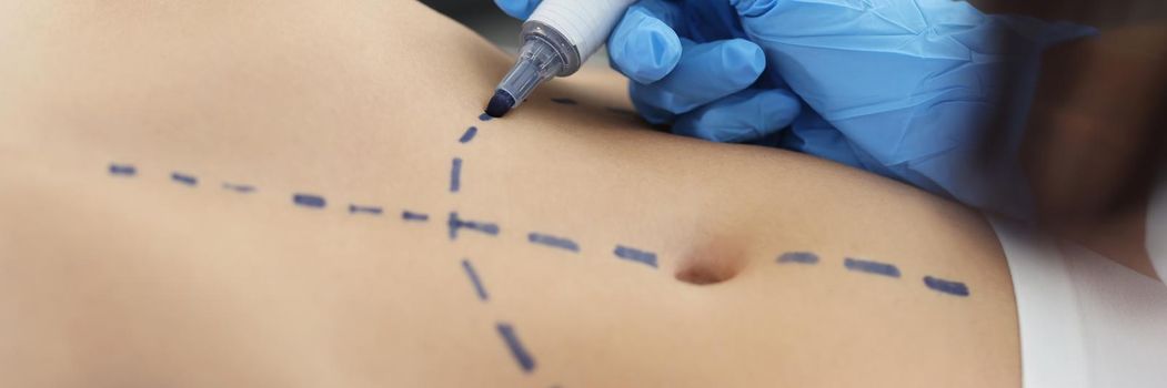 Close-up of plastic surgeon using marker pen while marking belly part of womans body. Procedure before plastic surgery. Cosmetic surgery, beauty concept