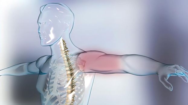 of the effects of arthritis on a healthy lumbar spine. 3d illustration