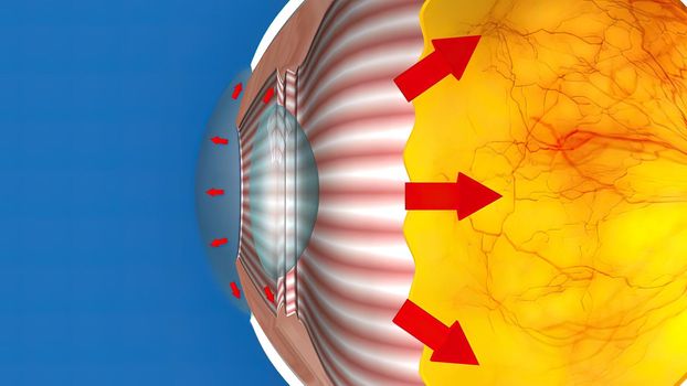 Low-tension or normal-pressure glaucoma. In normal-tension glaucoma the optic nerve is damaged even though the pressure in the eye is not very high. 3d illustration