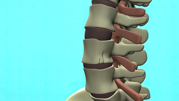 of the effects of arthritis on a healthy lumbar spine.3d illustration