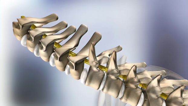 of the effects of arthritis on a healthy lumbar spine. 3d illustration