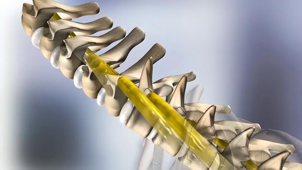 of the effects of arthritis on a healthy lumbar spine. 3d illustration