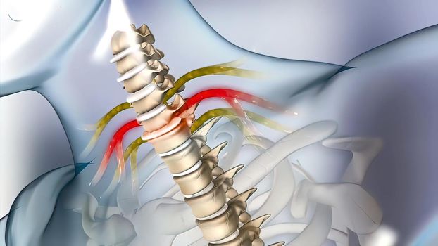 of the effects of arthritis on a healthy lumbar spine. 3d illustration