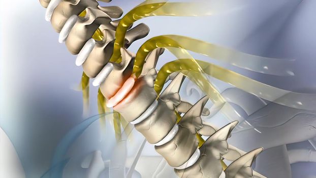 of the effects of arthritis on a healthy lumbar spine. 3d illustration