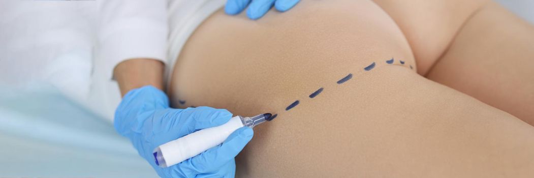 Close-up of surgeon drawing marks on female body before plastic operation. Beautician touch and draw correction lines on woman buttocks. Surgery concept