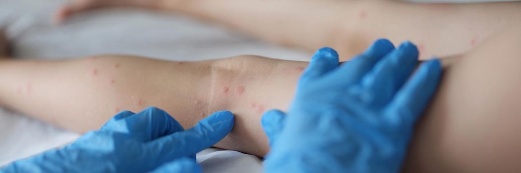 Close-up of family doctor examining red rash on legs of child in clinic. Kids naked legs on appointment, irritation on body. Medicine, healthcare concept