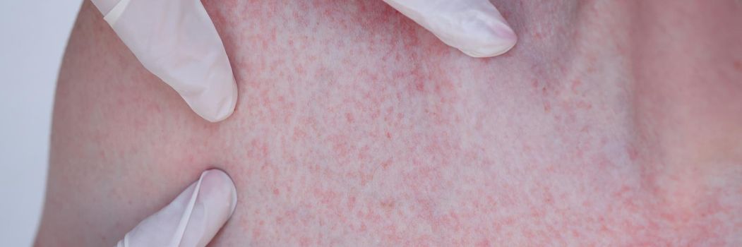 Doctor hands in gloves examining red rash on patient skin closeup. Diagnosis and treatment of allergic urticaria concept