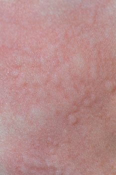 Urticaria on the skin. Red spots of an allergic reaction on the skin of a child. Urticaria symptoms close up.