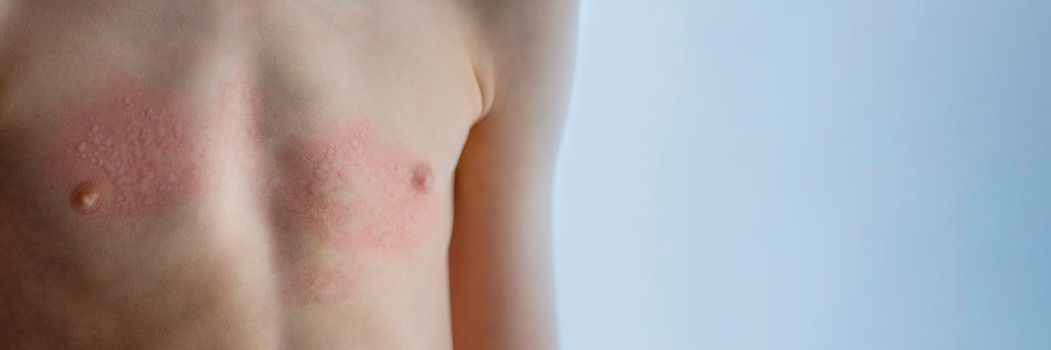 Urticaria on the skin. Red spots of an allergic reaction on the skin of a child. Urticaria symptoms close up.