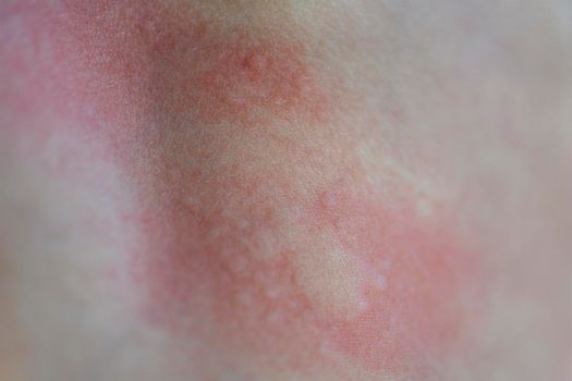 Urticaria on the skin. Red spots of an allergic reaction on the skin of a child. Urticaria symptoms close up.