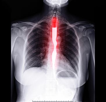 Esophagram or Barium swallow Front view showing esophagus for diagnosis GERD or Gastroesophageal reflux disease