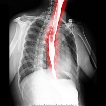 Esophagram or Barium swallow oblique view showing esophagus for diagnosis GERD or Gastroesophageal reflux disease