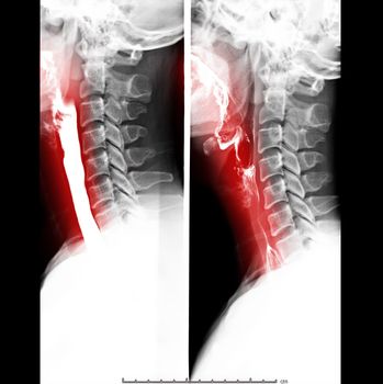 Esophagram or Barium swallow Lateral view showing esophagus for diagnosis GERD or Gastroesophageal reflux disease