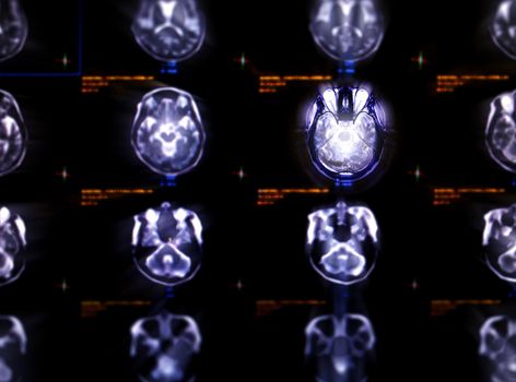 Selective focus of MRI brain axial view for detect a variety of conditions of the brain stroke disease.