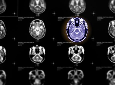 Selective focus of MRI brain axial view on blurred mri brain axial background.