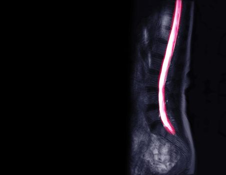 MRI L-S spine myelogram technique for diagnosis spinal cord compression.