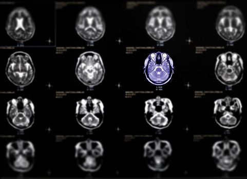 Selective focus of MRI brain axial view for detect a variety of conditions of the brain such as cysts, tumors, bleeding, swelling, developmental and structural abnormalities or infections .