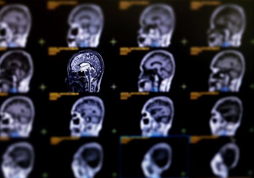 Selective focus of MRI brain sagittal plane for detect a variety of conditions of the brain such as cysts, tumors, bleeding, swelling, developmental and structural abnormalities or infections .