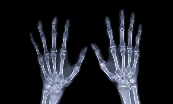 xray image of both hand AP view isolated on black background for diagnostic rheumatoid.