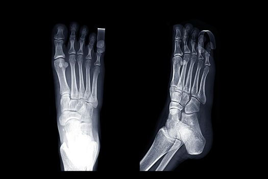 Comparison of X-ray Right foot image AP and oblique view with Finger Splint for diagnostic fracture and Gouty arthritis .