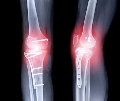 x-ray image of Right knee AP and Lateral view showing Total knee arthroplasty and fractures of the tibial plateau with plate and screw fixation.