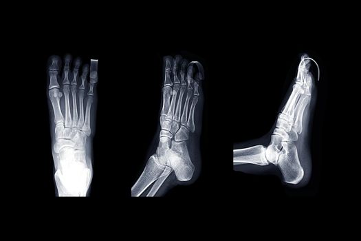 Comparison of X-ray Right foot image AP , oblique and lateral view with Finger Splint for diagnostic fracture and Gouty arthritis .