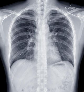 Chest X-ray or X-Ray Image Of human Chest for diagnosis tuberculosis . check up concept.