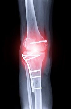 x-ray image of Right knee AP view showing Total knee arthroplasty and fractures of the tibial plateau with plate and screw fixation.