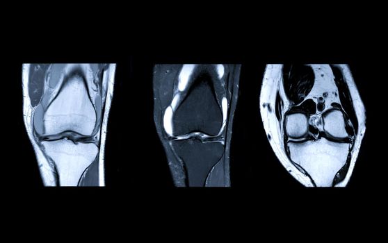Compare of MRI Knee joint or Magnetic resonance imaging coronal view for detect tear or sprain of the anterior cruciate ligament (ACL).