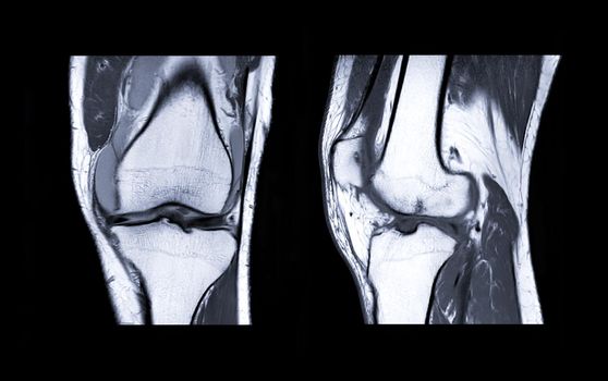 MRI Knee joint or Magnetic resonance imaging compare coronal and sagittal view for detect tear or sprain of the anterior cruciate ligament (ACL).