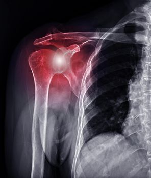 X-ray Shoulder joint for diagnosis shoulder joint dislocation.