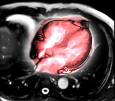 MRI heart or Cardiac MRI ( magnetic resonance imaging ) of heart vertical axis view showing 4 chamber of the heart for diagnosis heart disease.