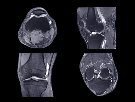 Magnetic resonance imaging or MRI knee comparison Axial, Coronal, sagittal and acl view view for detect tear or sprain of the anterior cruciate ligament (ACL).clipping path.