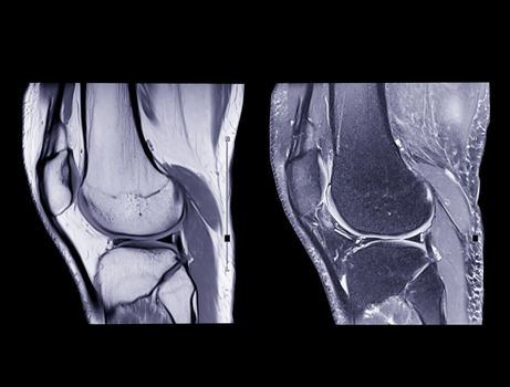 Magnetic resonance imaging or MRI knee comparison sagittal PDW and TIW view for detect tear or sprain of the anterior cruciate ligament (ACL).clipping path.