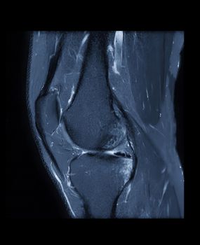 MRI knee or Magnetic resonance imaging of knee joint stir technique of sagittal view for fat suppression.
